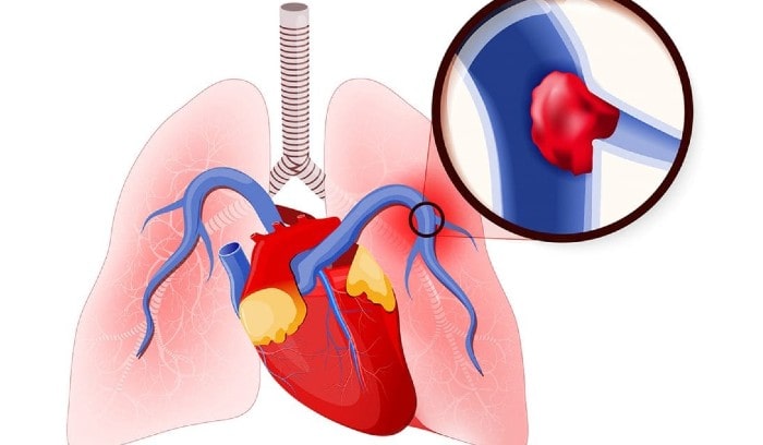 Pulmonary Thromboembolism Treatment in Sarjapur Road, Bangalore 